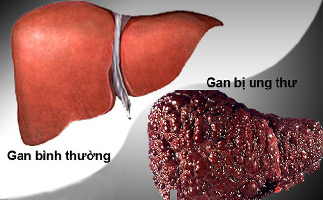 Những nguyên nhân gây ung thư gan